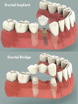 Ảnh minh họa: thay thế răng mất bằng  implant ( hình trên) hoặc cầu răng (hình duowisi)