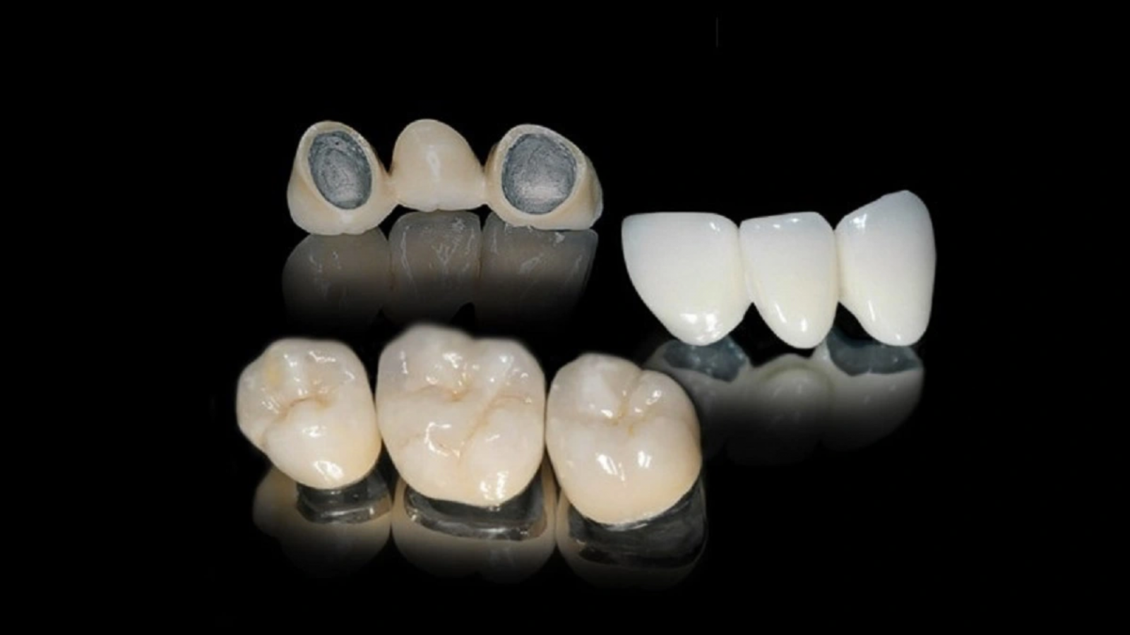răng sứ kim loại nha khoa 4U