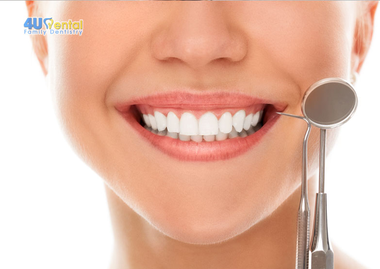 Lựa chọn tẩy trắng răng ở nhà hay nha khoa sẽ tốt hơn?